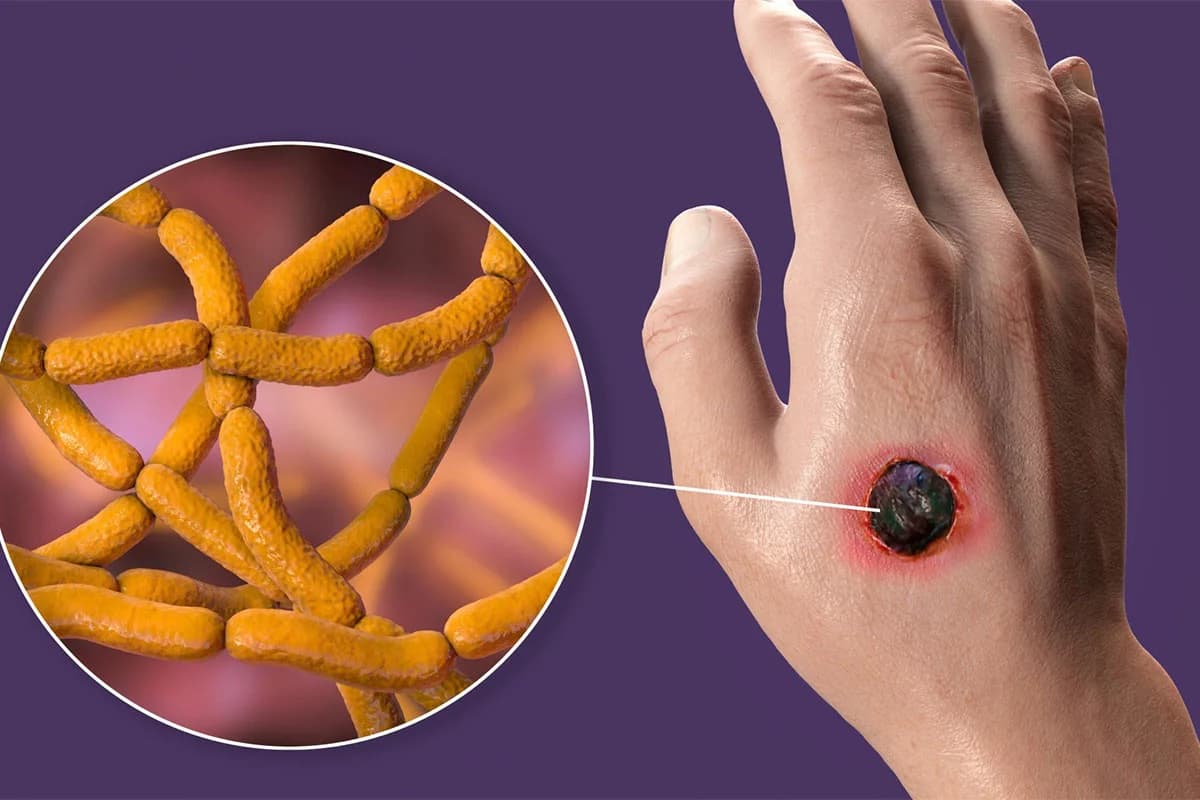 Thumbnail for পীরগাছায় ৮ জনের শরীরে অ্যানথ্রাক্স আতঙ্ক